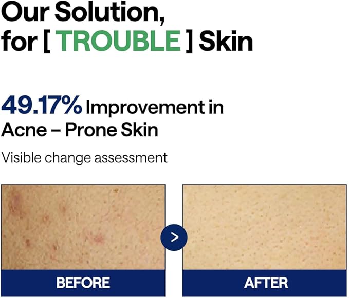 MEDIHEAL Teatree Trouble Pad - Square Cotton Facial Toner Pads with Tea Tree & Lactobacillus - Soothing to Calm Sensitive & Acne Prone Skin- Vegan Face Gauze 100