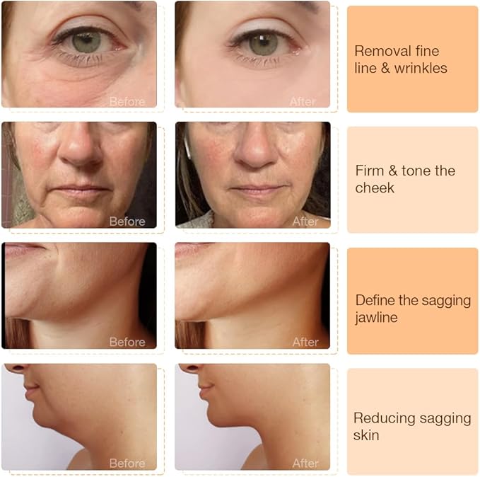 Skin Tightening Device | 6 in 1 Radio Frequency Skin Tightening Device | Professional Face Tightening | Lifting | Wrinkle Reducing | Depuff | Absorb | at Home RF Anti Aging Face Beauty Device