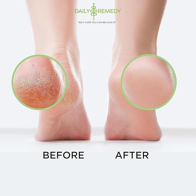 Tea Tree Oil Foot Soak with Epsom Salt - Made in USA - for Toenail irritations, Athletes Foot, Stubborn Foot Odor Scent, Softens Calluses & Soothes Sore Tired Feet - 2 Pack