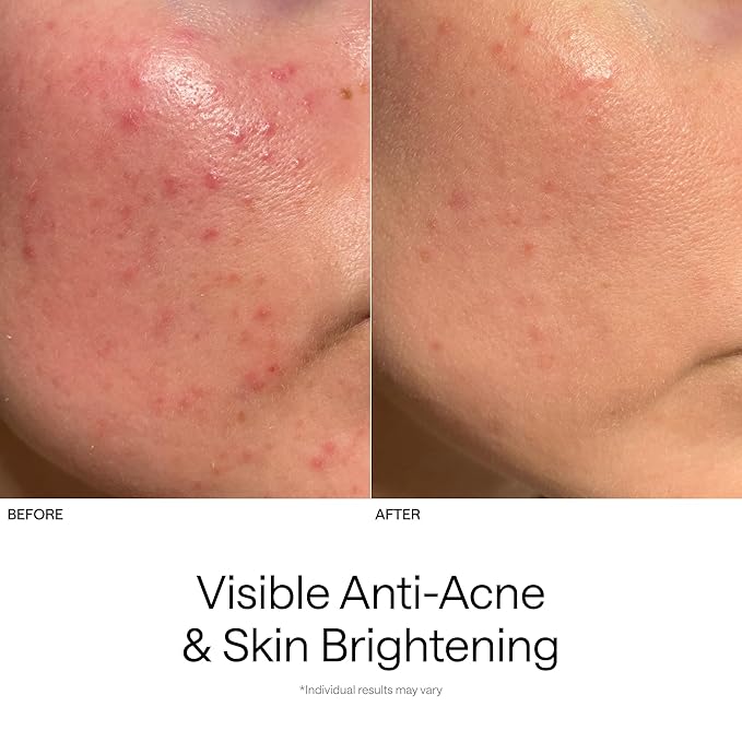 Ulike ReGlow Lite LED Mask With 3 Modes for Anti-Acne & Anti-Aging, Powerful LED Beads With Red, Blue and Mixed Light, 3D Facial Comfort Fit, Red Light Therapy Skin Care At Home