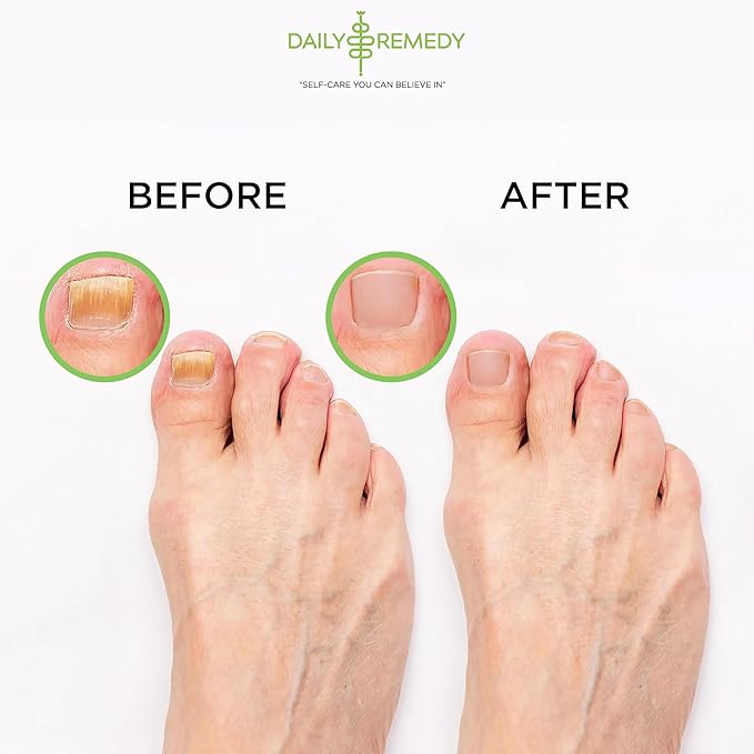 Tea Tree Oil Foot Soak with Epsom Salt - Made in USA - 16 Ounces