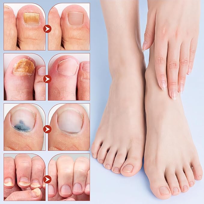 Toenail Treatment Extra Strength - Nighttime Nail Patches,Overnight Toe Nail Treatments for Damaged Nails Foot Nails Repair and Care (21Pcs)