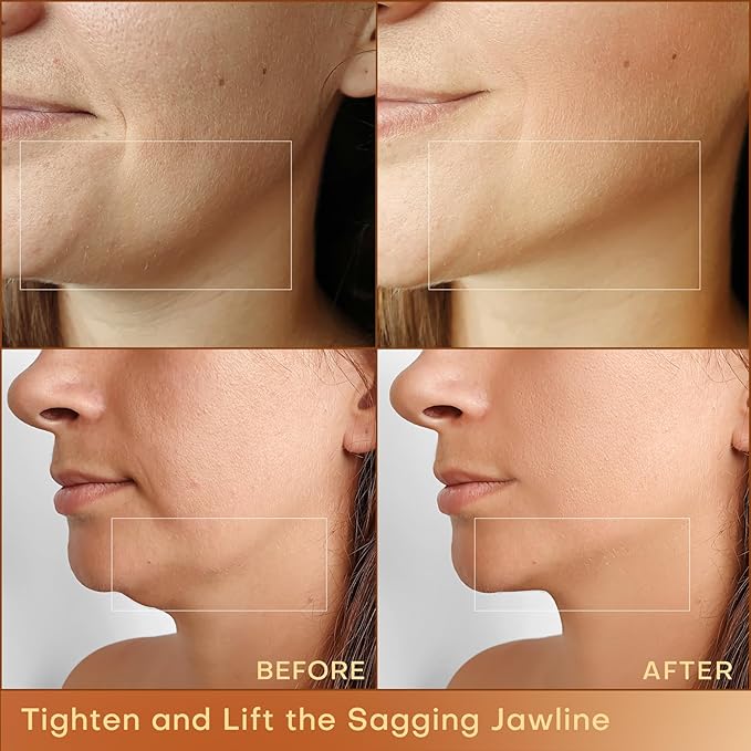 MLAY Professional RF Beauty Machine, Radio Frequency Face Machine with 2 Probes, at Home Radio Frequency Skin Tightening for Lifting, Wrinkle Reducing, Anti Aging - Salon Effects（Gel Included）