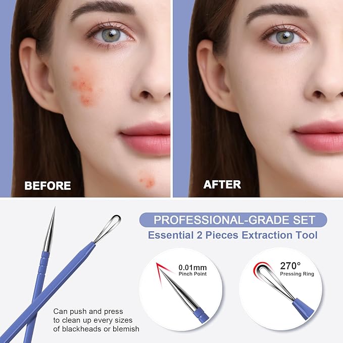 Teenitor Pimple Extractor Acne Treatment Surgical Grade Blackhead Comedone Removal 2-in-1 Popper Tool for Face Nose (Blue)